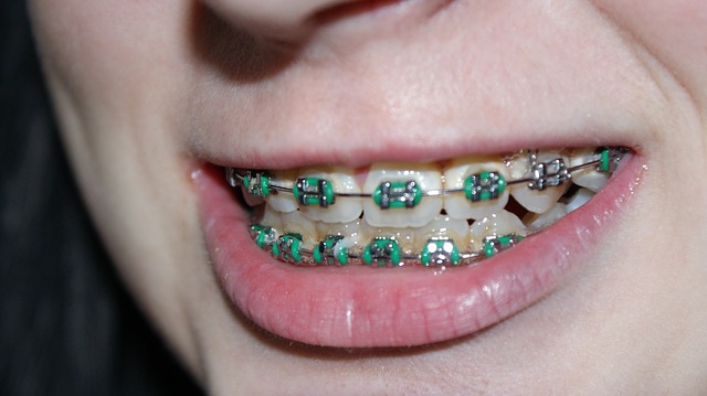 dental braces